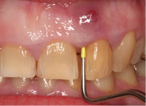 teeth endodontics